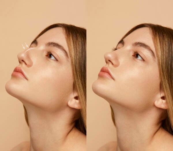 Rinoplastía estética o funcional